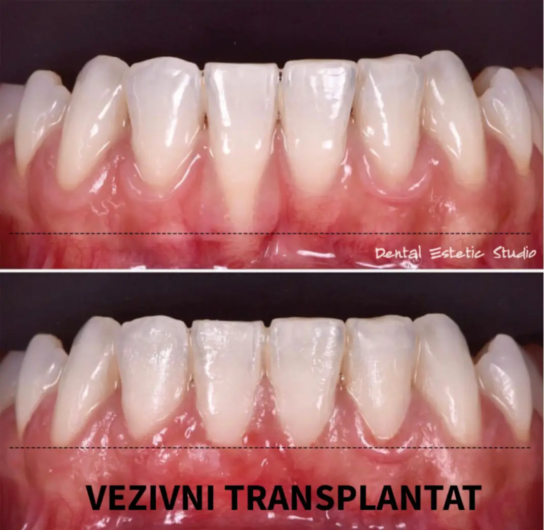 povlačenja gingive riješeni mikrokiruškim zahvatom vezivnim transplantatom_1072x1044 povlačenja gingive riješeni mikrokiruškim zahvatom vezivnim transplantatom