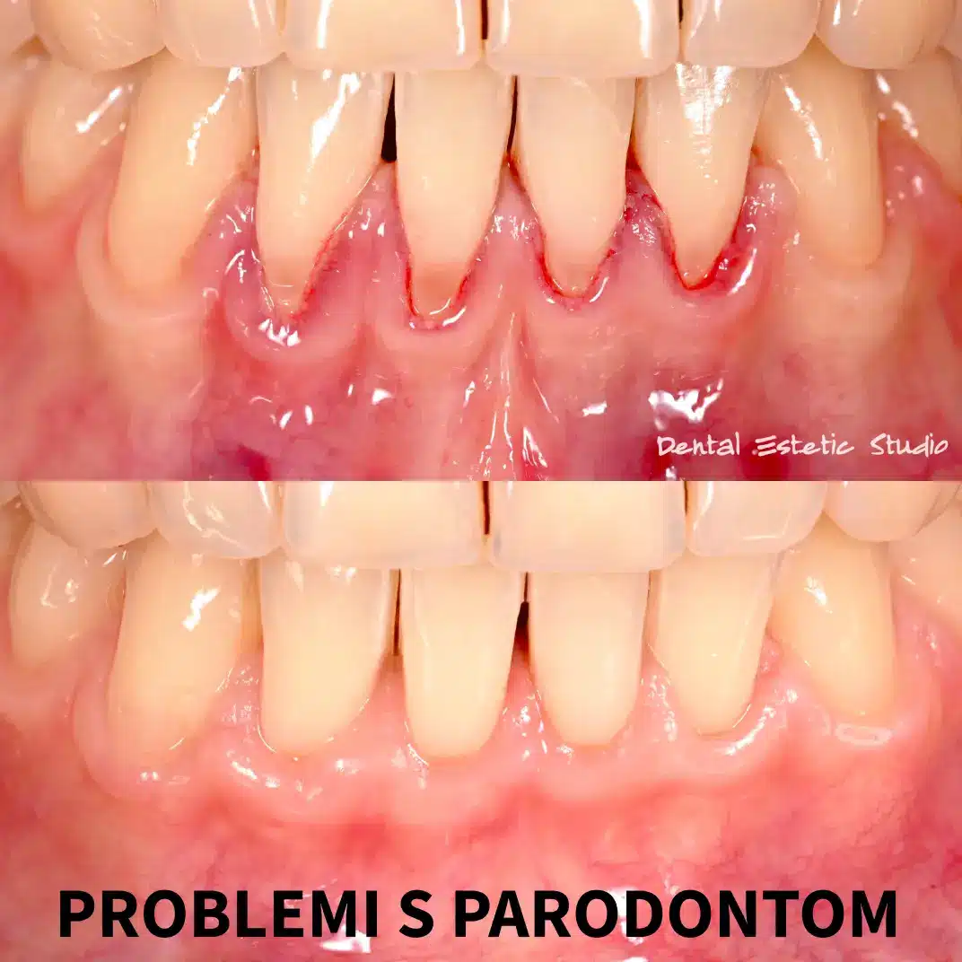 problemi s parodontom_1072x1072 problemi s parodontom